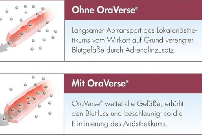 Vergleich der Wirkung von Lokalanästhesie mit und ohne OraVerse.