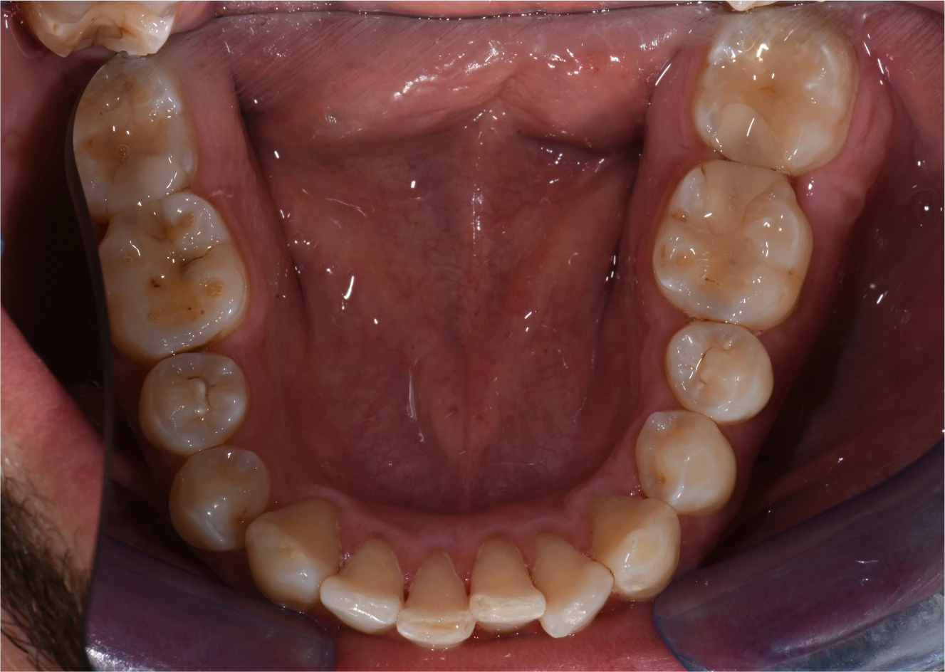 Detailaufnahme des unteren Zahnbogens nach einer Aligner-Therapie, mit korrekt ausgerichteten Zähnen für eine verbesserte Zahnstellung und Mundgesundheit.